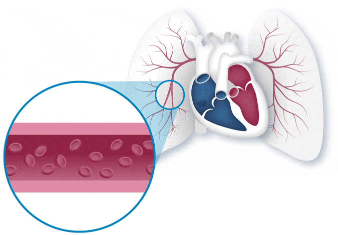 Anatomical depiction of Pulmonary Arterial Hypertension's effects on the vessels in the lungs