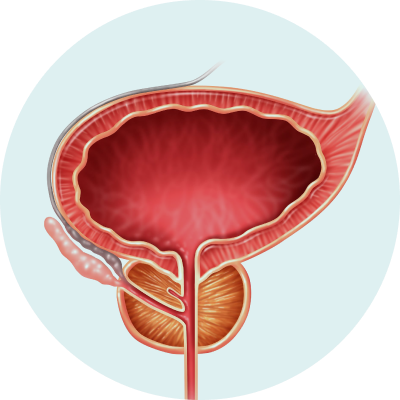 Prostate
