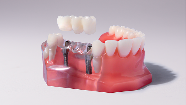 Dental implant and bridge model