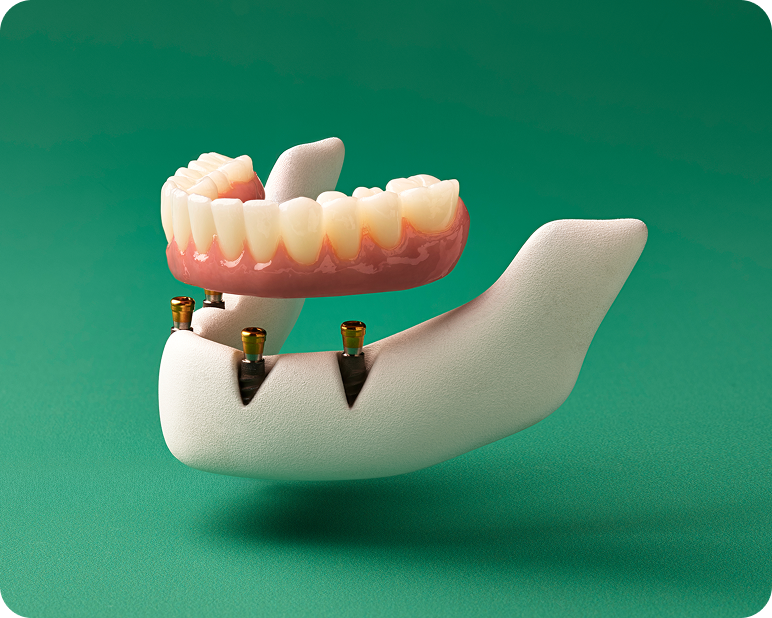 3D model of a lower fixed full-arch implant supported by four dental implants, shown slightly separated to demonstrate attachment.