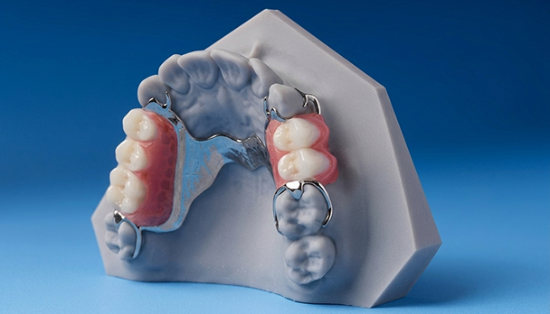 Traditional cast metal partial denture on a dental model, showing the rigid metal framework and standard acrylic gum base.