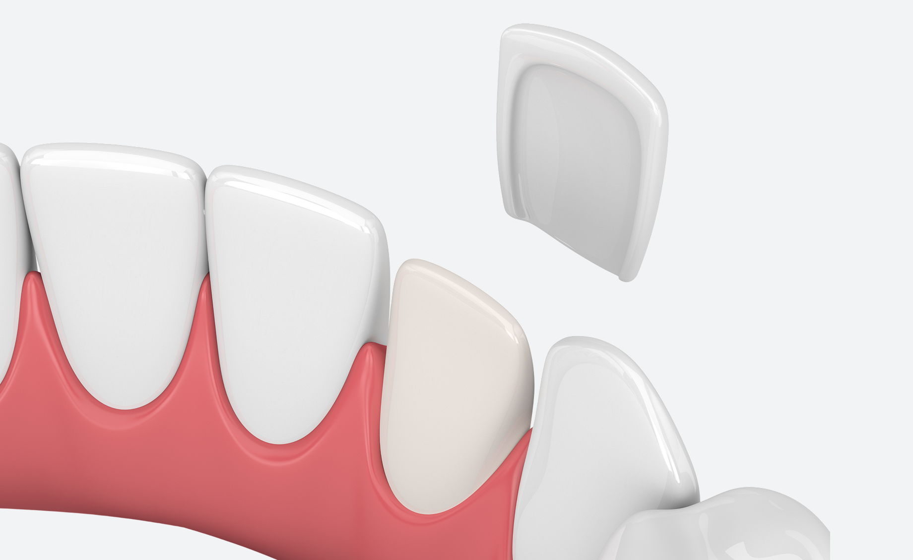 Illustration of composite dental veneer being placed on a lower front tooth.
