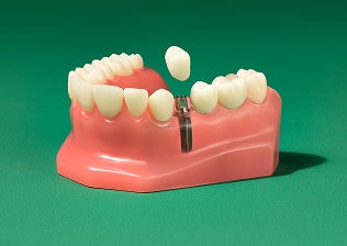 Single tooth dental implant model showing an artificial tooth placed into the jaw.