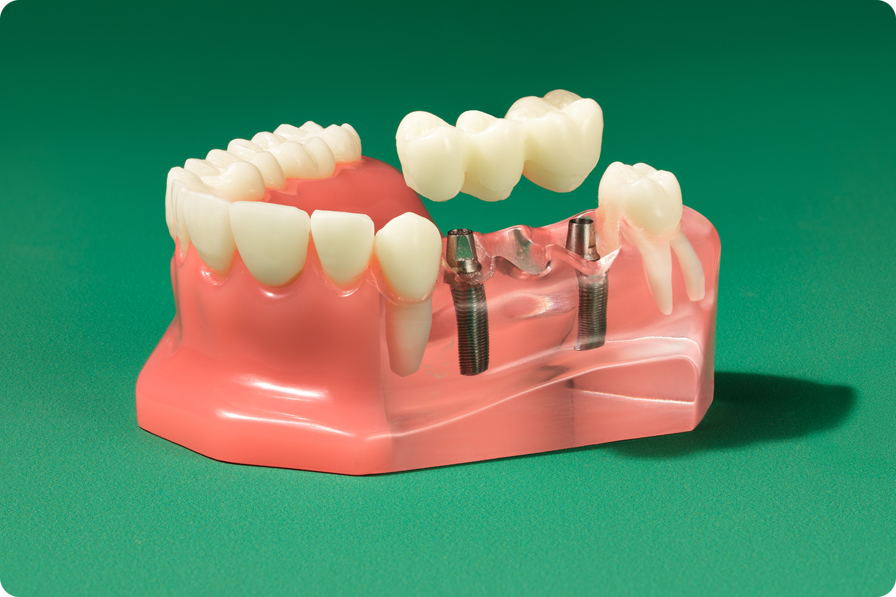Dental implant bridge model showing replacement teeth supported by two titanium implants in the lower jaw.