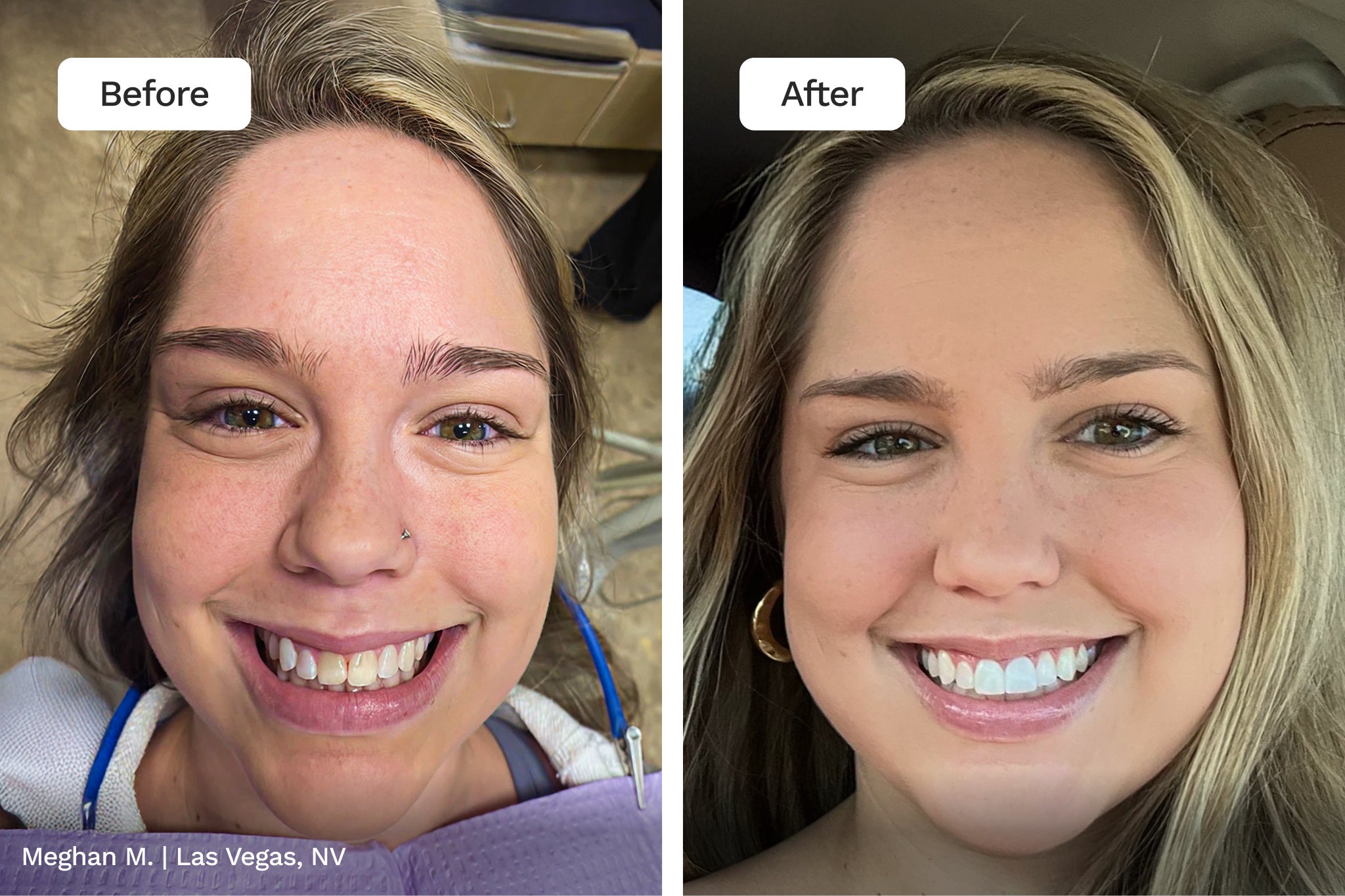 Woman smiling at the camera before and after cosmetic dental treatment.