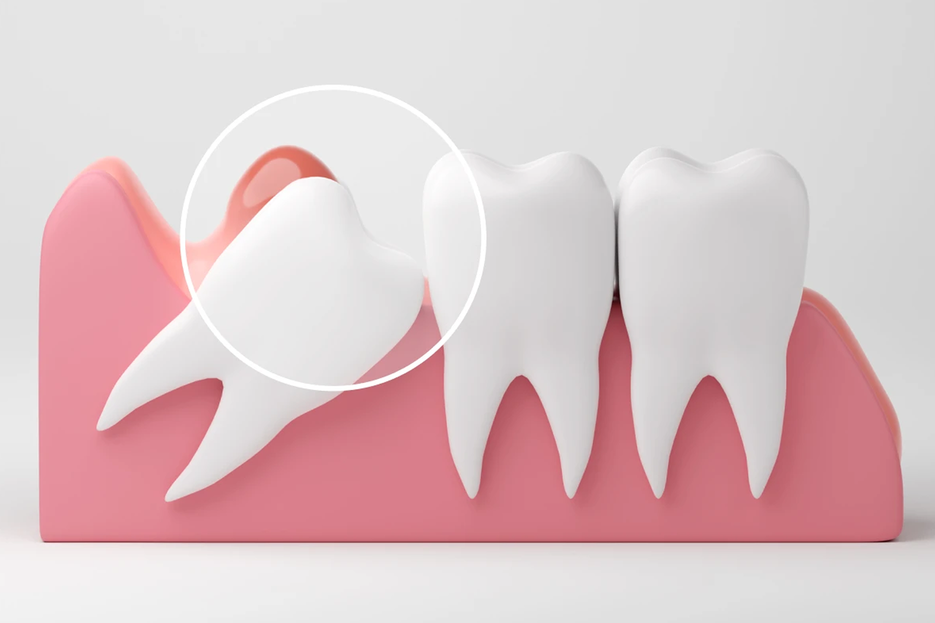Illustration of impacted wisdom tooth highlighted for removal next to healthy teeth.