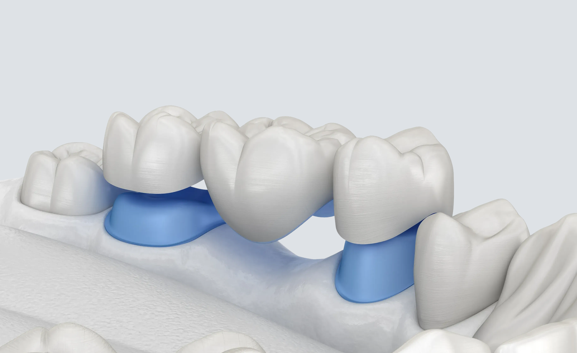3D illustration of a dental bridge supported by adjacent teeth.
