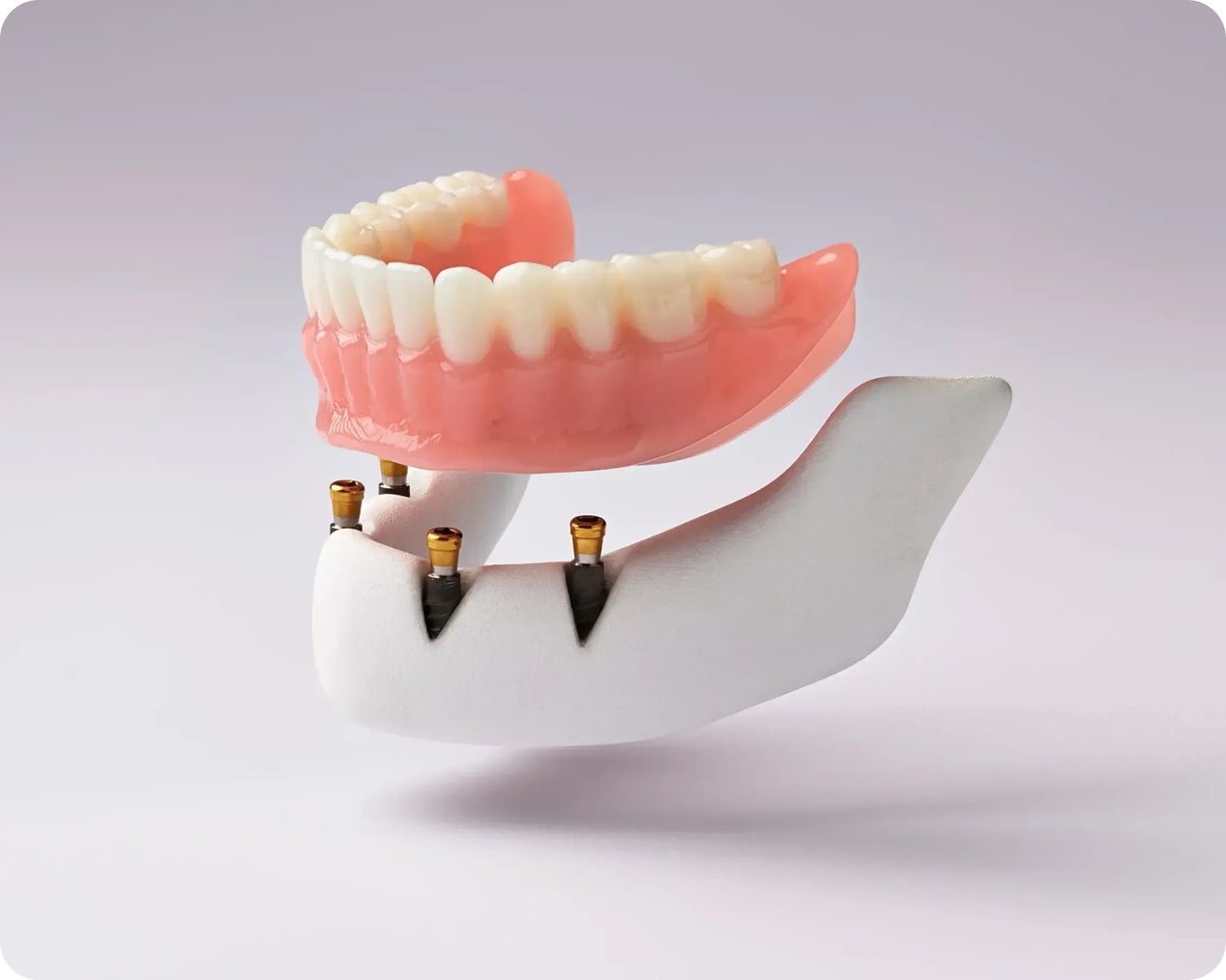 Implant Dentures