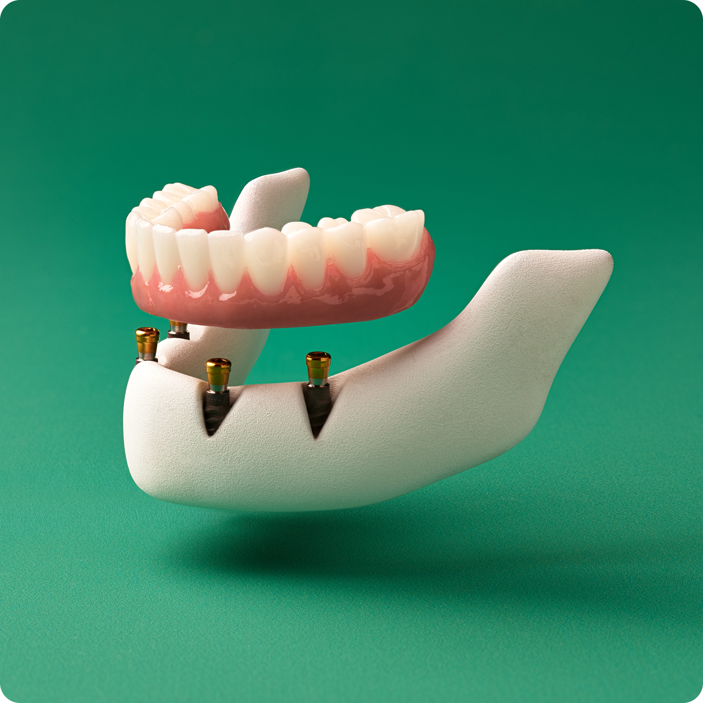 3D illustration of a lower full-arch fixed permanent implant restoration supported by multiple dental implants, shown slightly separated to demonstrate attachment.