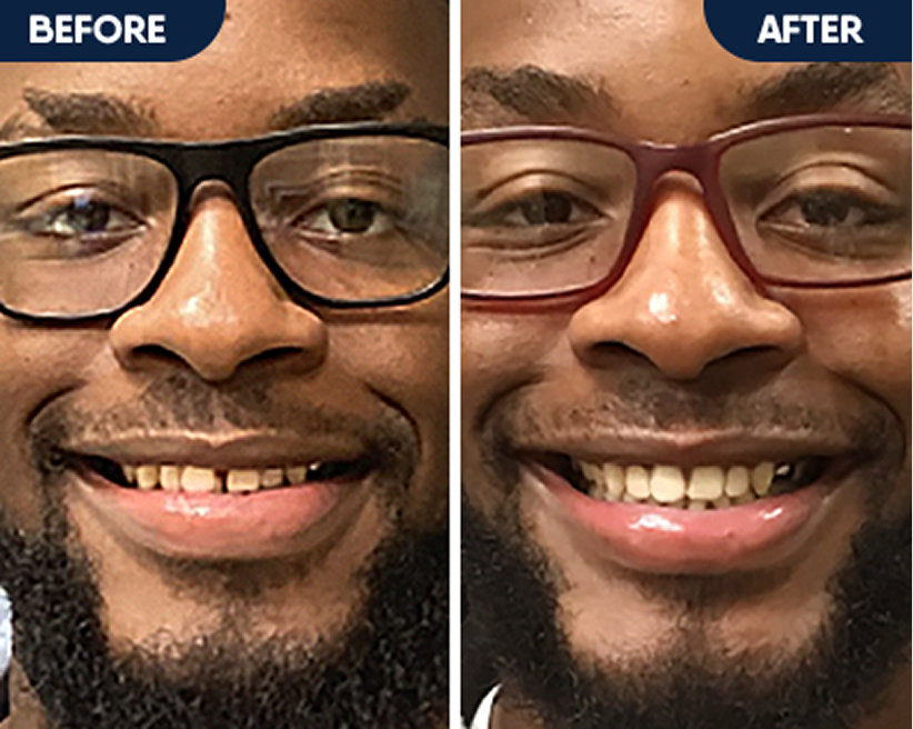 Before and after dental smile enhancement