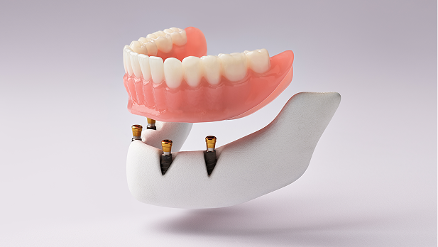 Dental implant-supported denture
