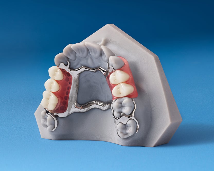 A partial denture model shown as an affordable option to replace a few missing teeth.