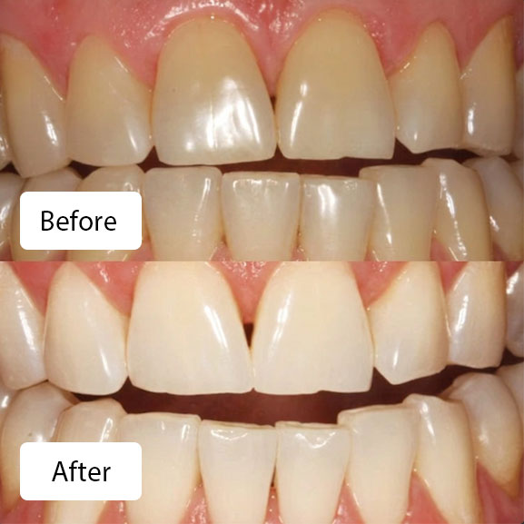Before and after professional teeth whitening treatment, comparing yellowed teeth to whitened, more uniform teeth.