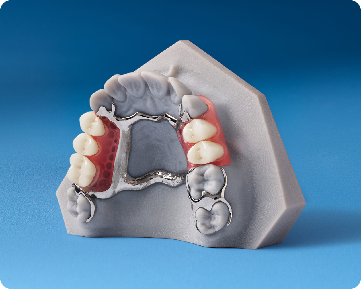 alt text: Dental model of an upper removable partial denture with acrylic base and metal framework.