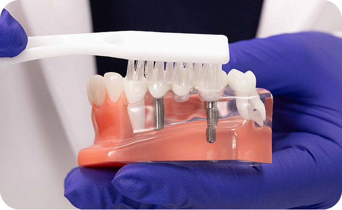 Alt text:
Dental professional brushing an implant bridge model.