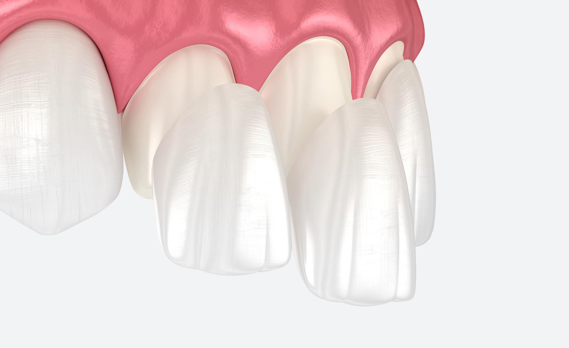 Illustration of porcelain laminate veneers placed over upper front teeth.