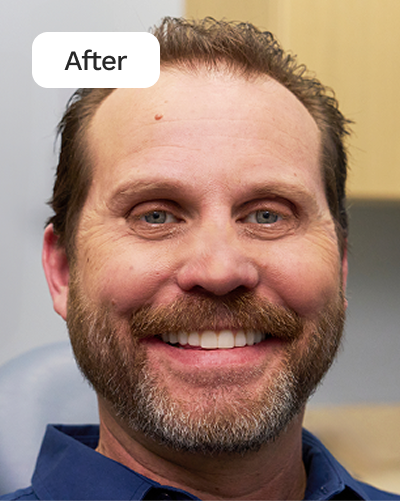 WB AD Full Dentures LF AJ After 20260129