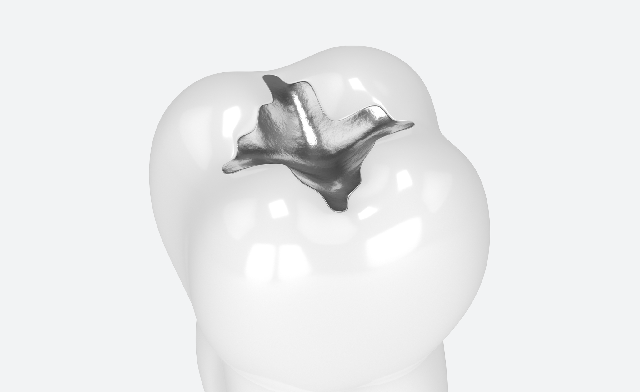 Illustration of a tooth restored with a silver amalgam filling.