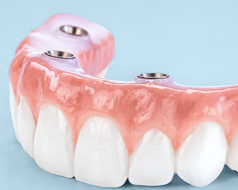  Detailed top view of Endura dental implant connection points and custom gums