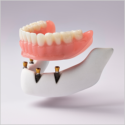 Alt Text: 3D model of an implant denture with an acrylic gum base, designed to snap securely onto four dental implants in the lower jaw.
