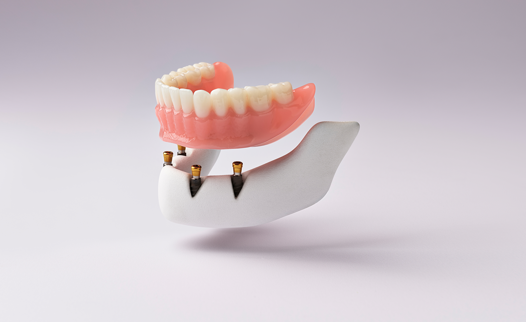 Implant-supported lower denture model positioned above dental implants.