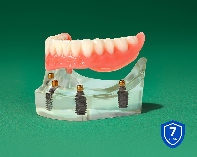 Fixed full arch dental implant model displayed above dental implants with a 7-year warranty badge.