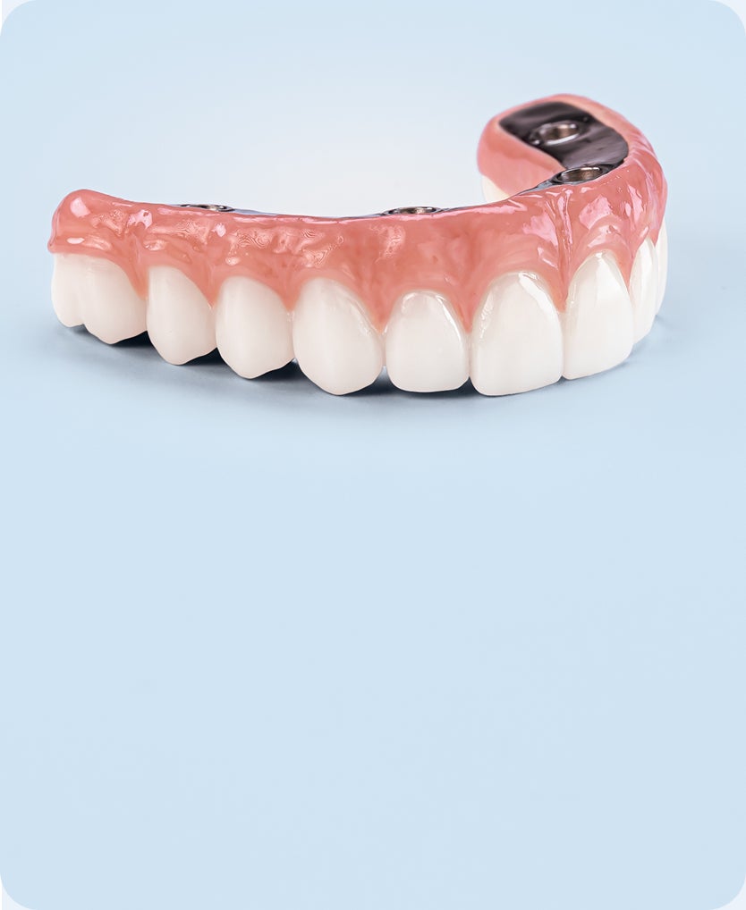 full arch dental implant prosthesis with natural-looking teeth and visible implant structure, representing essential full mouth dental implant solution