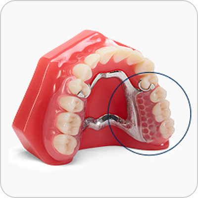 Alt Text: Flexilytes Combo partial denture on a dental model, highlighting the metal framework combined with a flexible, gum-colored base.