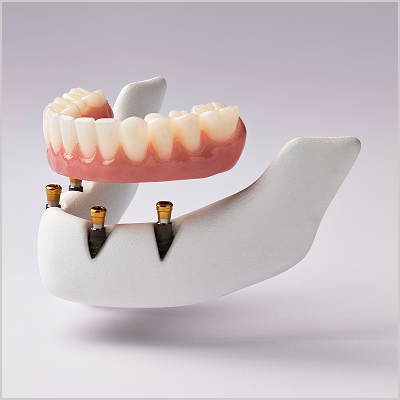 alt text: 3D model of a fixed full arch implant with a streamlined profile, designed to permanently attach to four dental implants in the lower jaw.