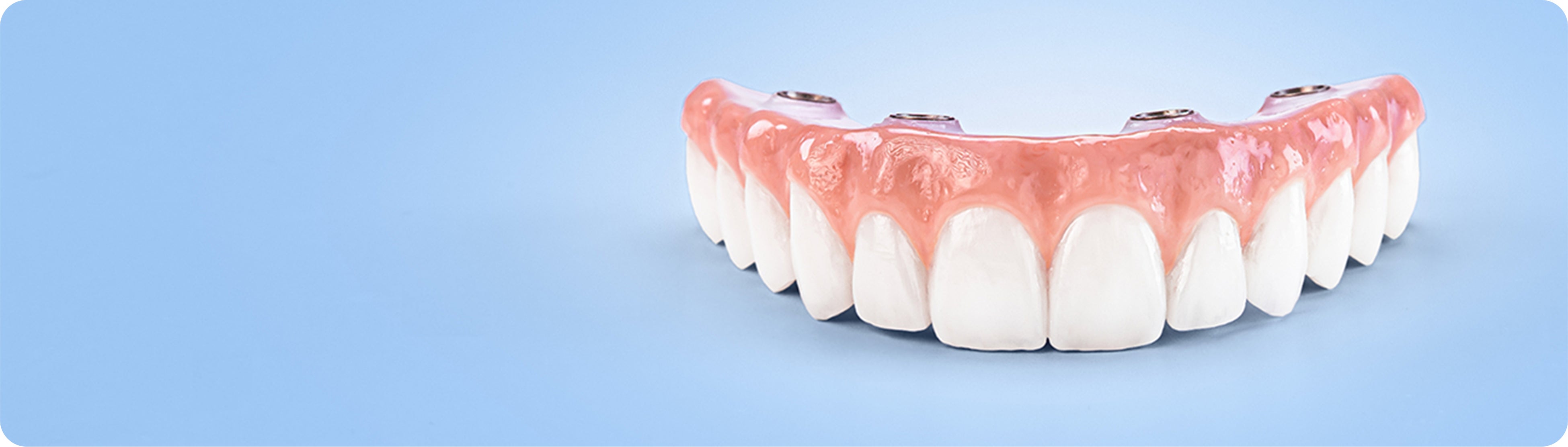 full arch dental implant prosthesis with natural-looking teeth and visible implant structure, representing essential full mouth dental implant solution