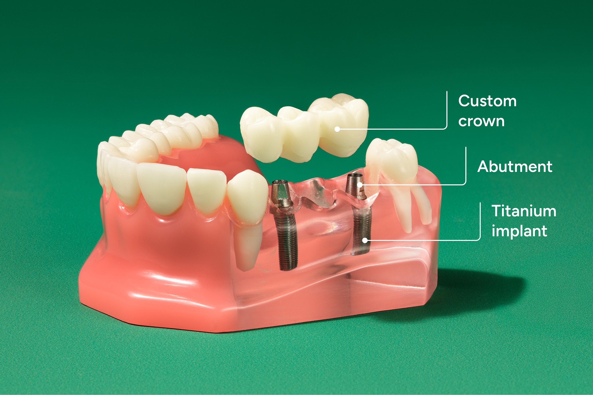Labeled diagram against green background showing the parts of an implant bridge, including the custom crown, abutment, and titanium implant.