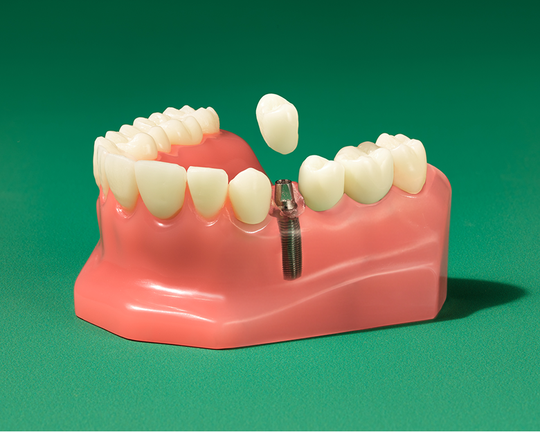 WB AD SingleToothImplant PDP Carousel 1 Mobile 20260122