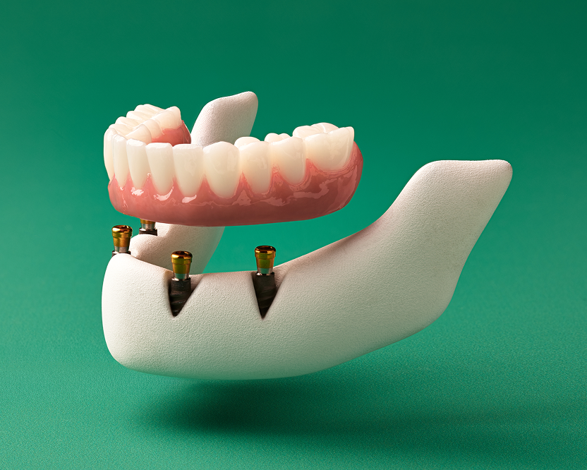WB DentalImplantCost Fixed Full Arch Multicard1 832x666 2026527