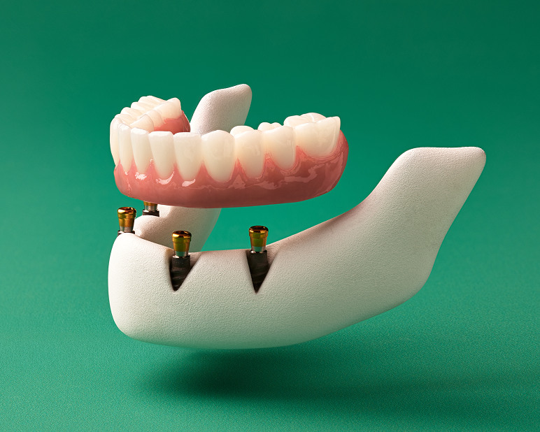 3D model of a lower fixed full-arch implant supported by four dental implants, shown slightly separated to demonstrate attachment.