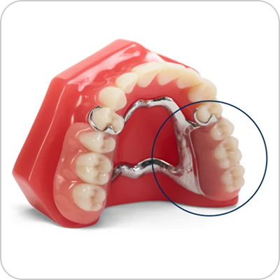 Alt Text: Traditional cast metal partial denture on a dental model, showing the rigid metal framework and standard acrylic gum base.