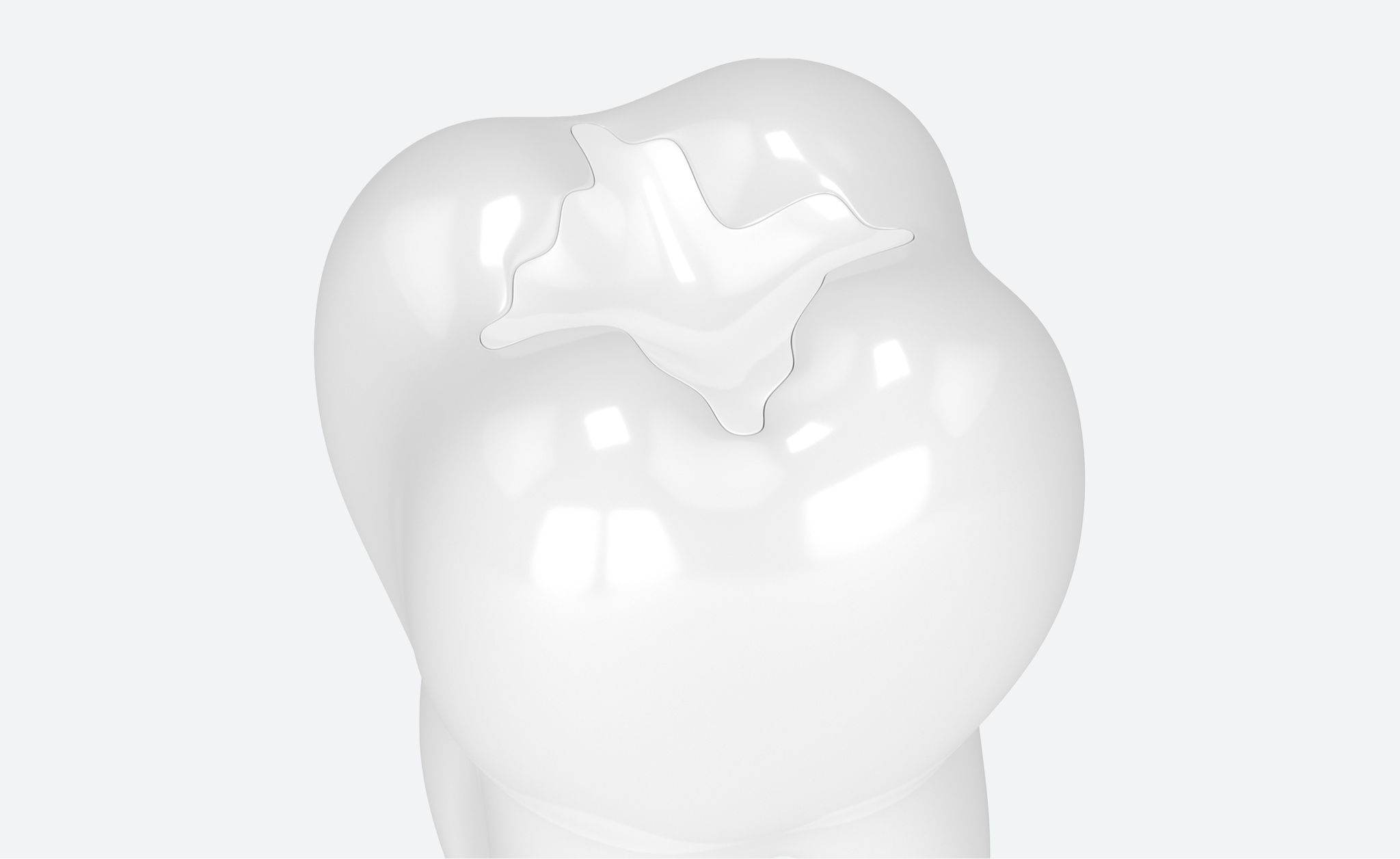 Illustration of a tooth restored with a tooth-colored composite filling.
