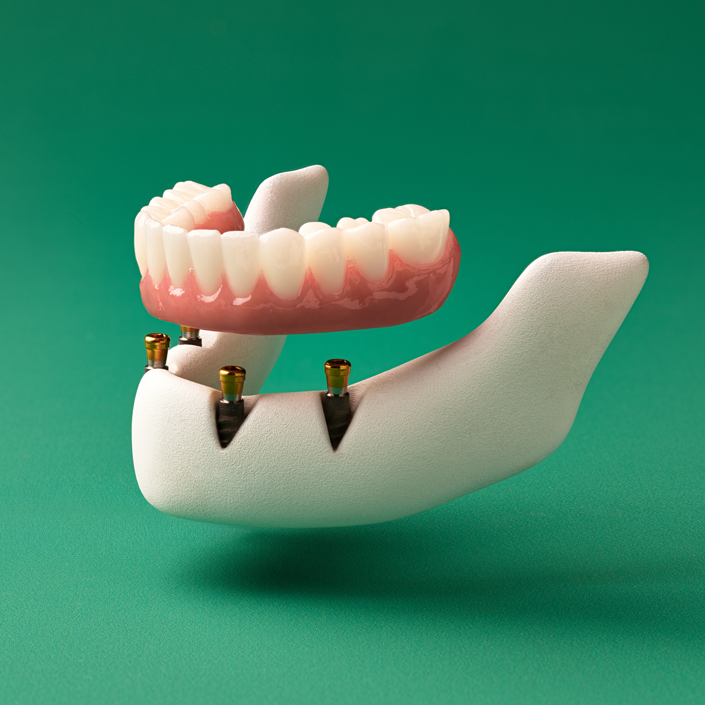 3D model of a lower fixed full-arch permanent implant restoration supported by four dental implants, shown slightly separated to demonstrate attachment.