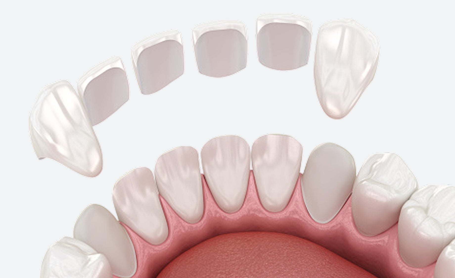 Illustration of snap-on dental veneers positioned above lower teeth.