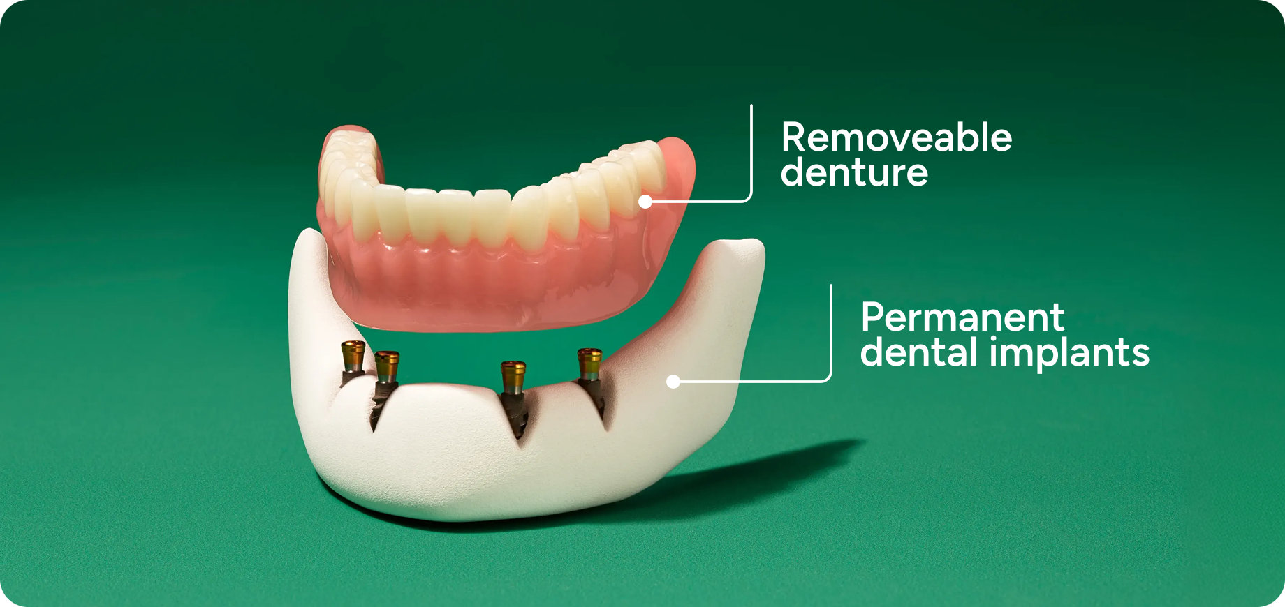 Diagram illustrating the components of an implant-supported denture, showing a removable denture positioned above four permanent dental implants in the lower jaw.
