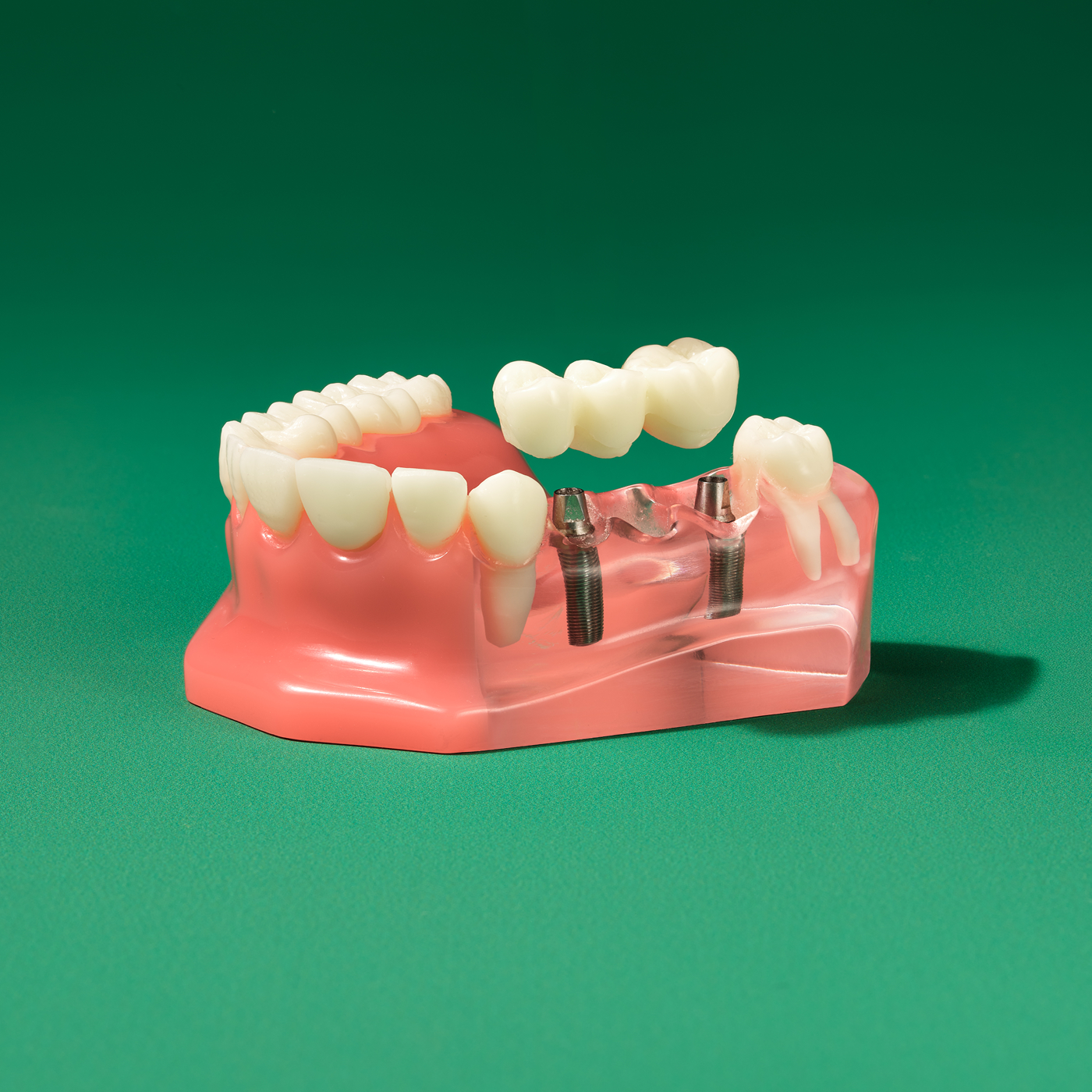 Dental implant bridge model showing multiple replacement teeth supported by two implants in the lower jaw.
