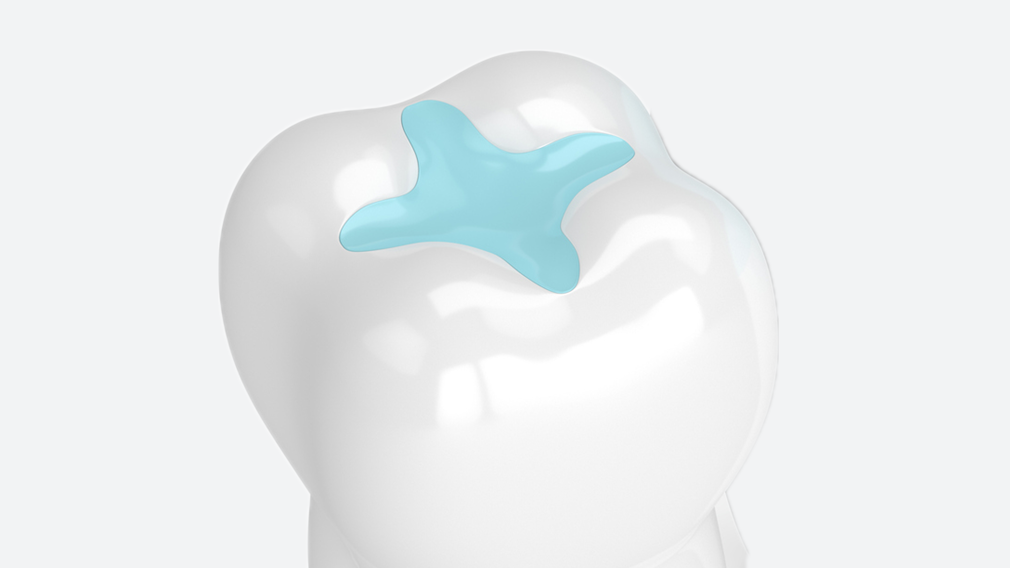 Illustration of a tooth restored with a glass ionomer filling.