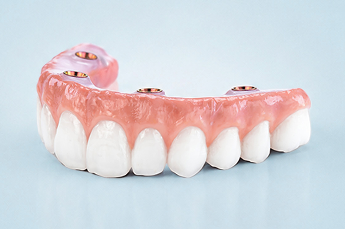 ClearChoice Endura essential artisan-crafted zirconia dental implant arch