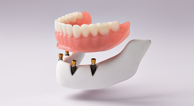 Implant-supported lower denture model positioned above dental implants.