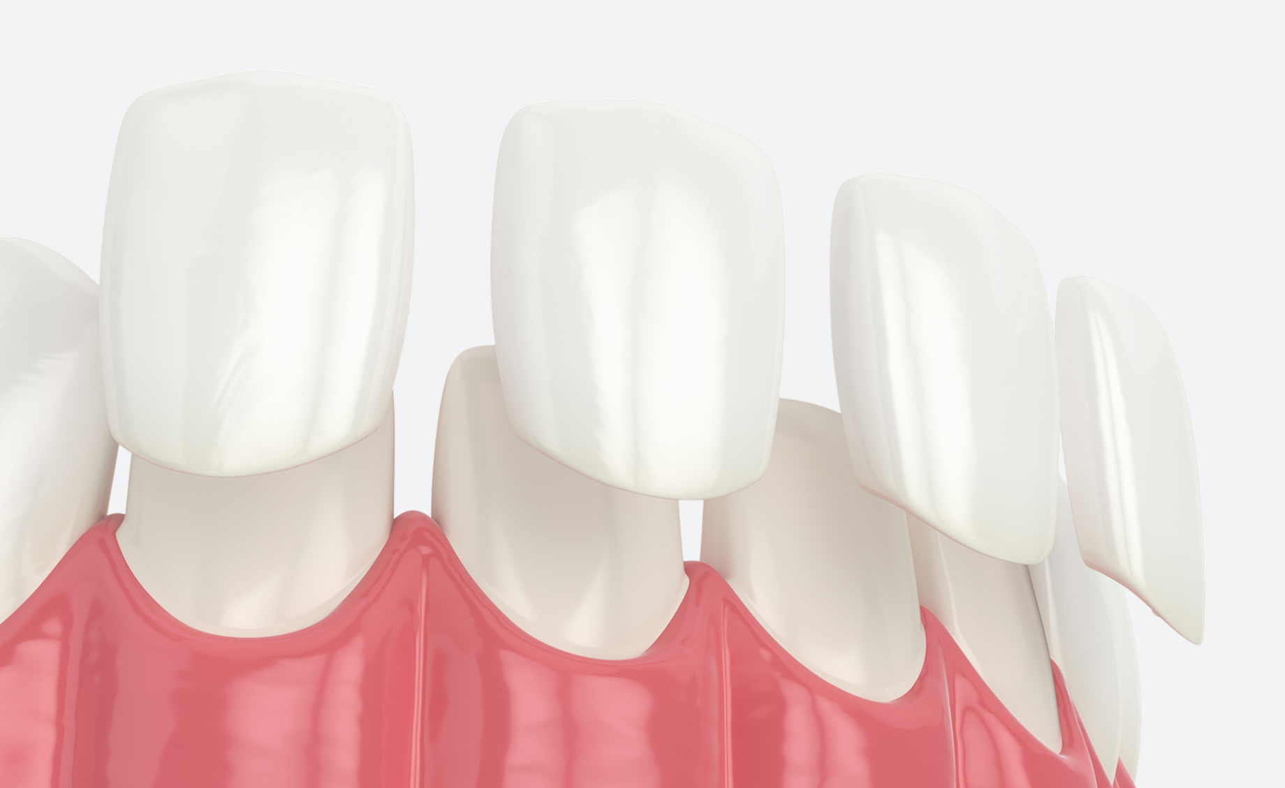 Close-up illustration of porcelain dental veneers placed over lower front teeth.