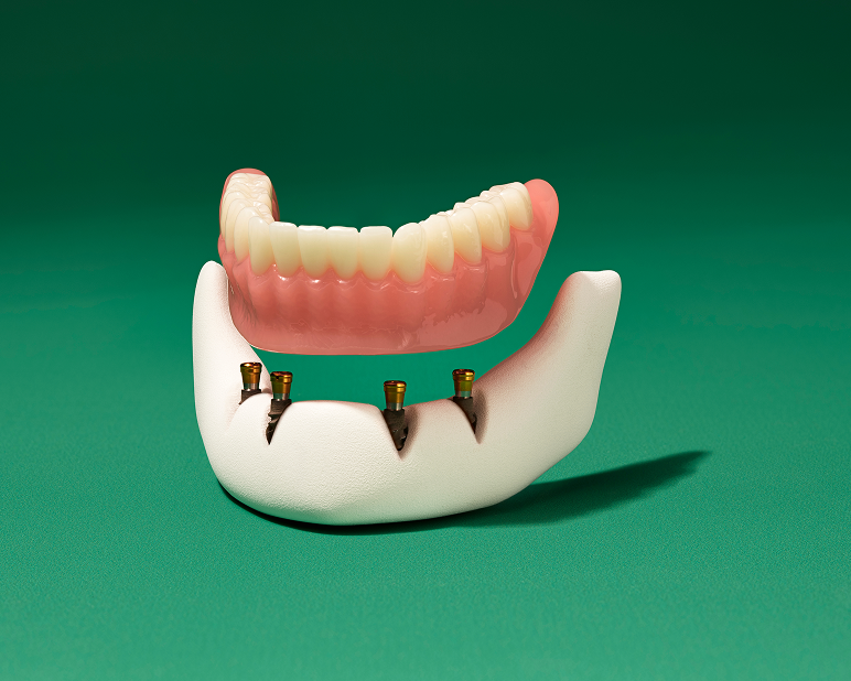 Implant-supported denture