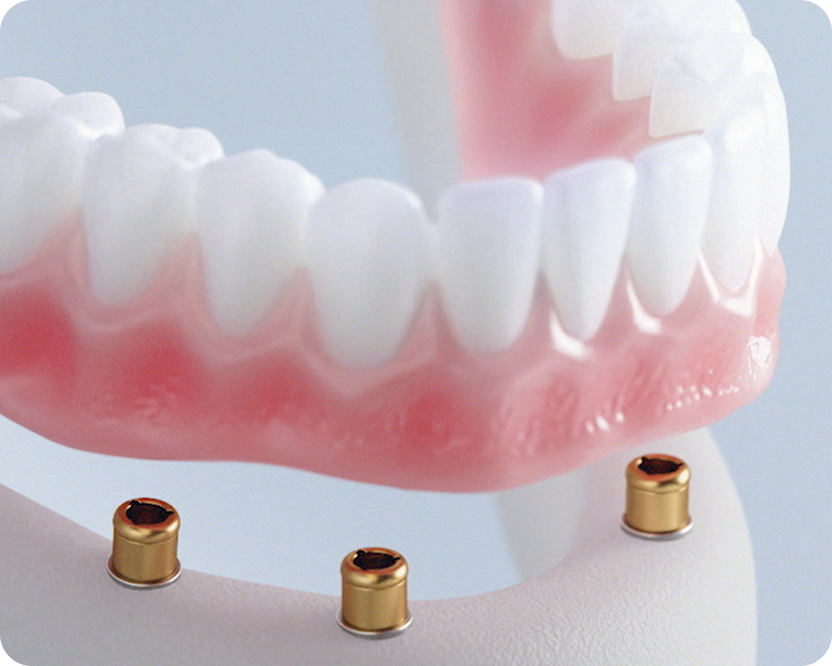 Implant-supported denture model