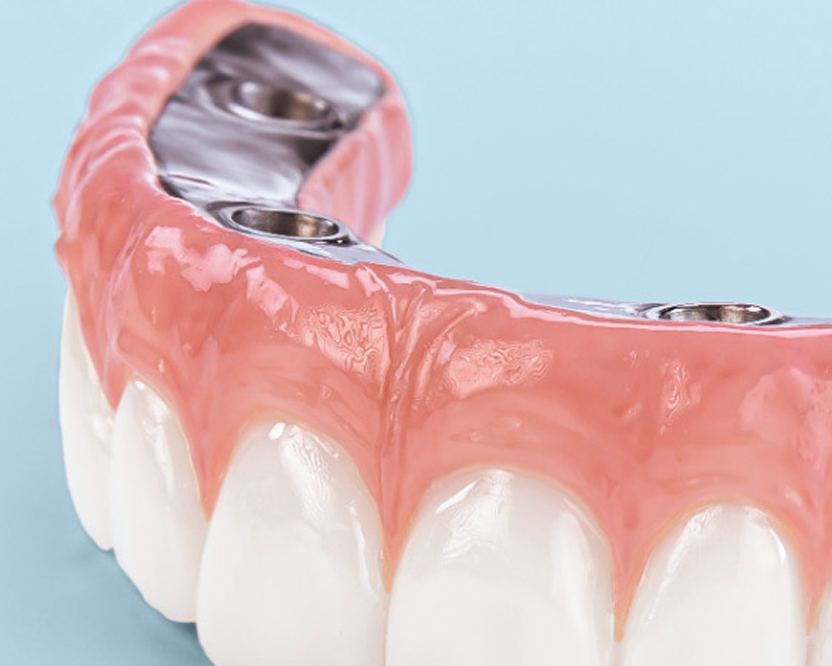 Close-up detail of the realistic gum line and teeth on a ClearChoice dental arch