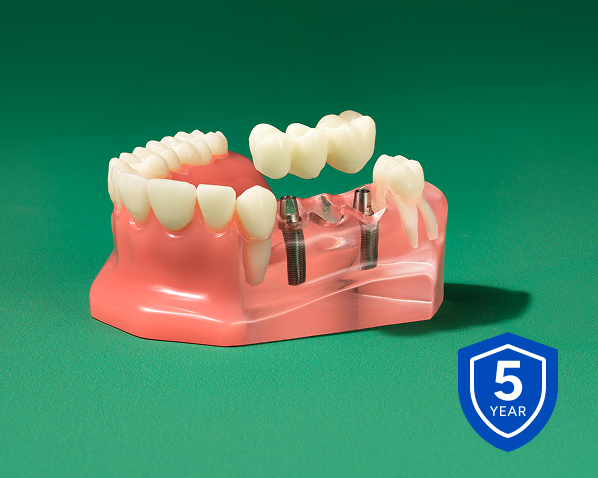 Alt text:
Dental implant bridge model showing replacement teeth supported by implants with a 5-year warranty badge.