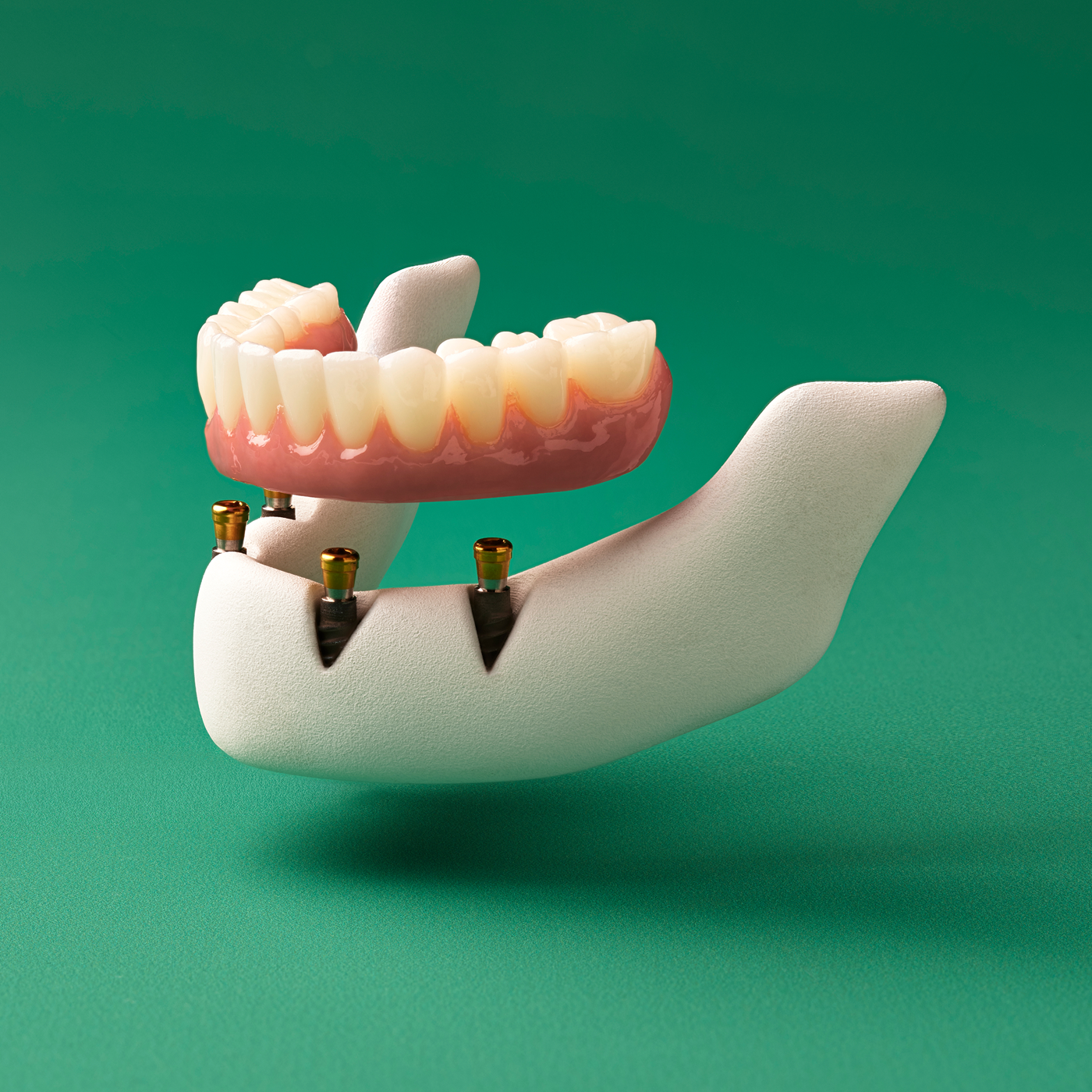 3D model of a lower fixed full-arch permanent implant restoration supported by four dental implants, shown slightly separated to demonstrate attachment.