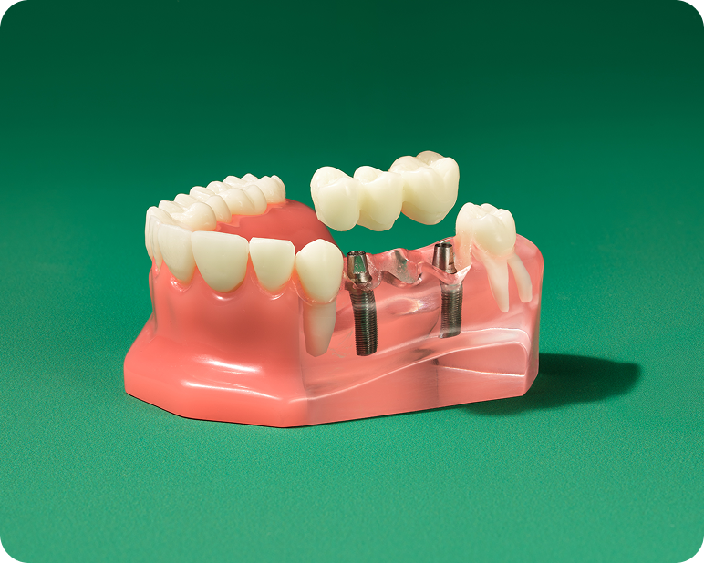 Implant-supported dental bridge model showing three connected replacement teeth anchored by two dental implants.